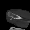 SPORK, NICO - 22.03.1976 - 02.08.2022 - CT obere Extremität - 17:59:38